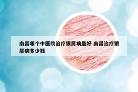 南昌哪個(gè)中醫(yī)院治療銀屑病最好 南昌治療銀屑病多少錢