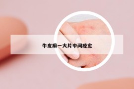 牛皮癬一大片中間痊愈