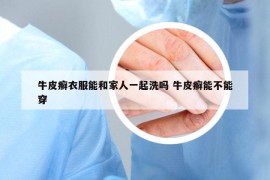 牛皮癬衣服能和家人一起洗嗎 牛皮癬能不能穿