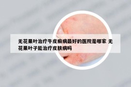 無花果葉治療牛皮癬病最好的醫(yī)院是哪家 無花果葉子能治療皮膚病嗎