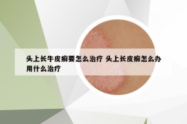 頭上長牛皮癬要怎么治療 頭上長皮癬怎么辦用什么治療