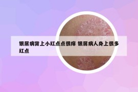 銀屑病背上小紅點點很癢 銀屑病人身上很多紅點