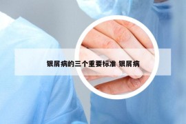 銀屑病的三個(gè)重要標(biāo)準(zhǔn) 銀屑病