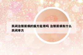 民間治銀屑病的偏方能用嗎 治銀屑病有什么民間單方