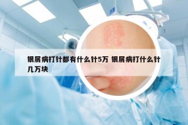 銀屑病打針都有什么針5萬 銀屑病打什么針幾萬塊