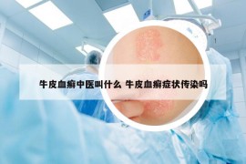 牛皮血癬中醫(yī)叫什么 牛皮血癬癥狀傳染嗎