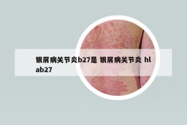 銀屑病關(guān)節(jié)炎b27是 銀屑病關(guān)節(jié)炎 hlab27