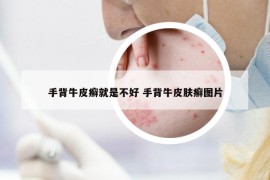手背牛皮癬就是不好 手背牛皮膚癬圖片