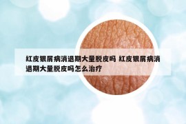 紅皮銀屑病消退期大量脫皮嗎 紅皮銀屑病消退期大量脫皮嗎怎么治療