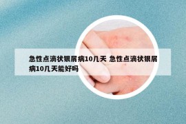 急性點滴狀銀屑病10幾天 急性點滴狀銀屑病10幾天能好嗎
