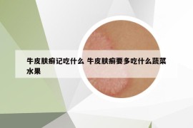 牛皮膚癬記吃什么 牛皮膚癬要多吃什么蔬菜水果