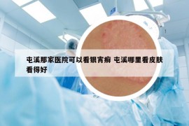 屯溪那家醫(yī)院可以看銀宵癬 屯溪哪里看皮膚看得好
