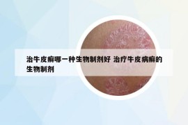 治牛皮癬哪一種生物制劑好 治療牛皮病癬的生物制劑