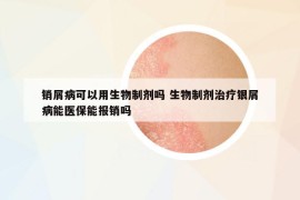 銷屑病可以用生物制劑嗎 生物制劑治療銀屑病能醫(yī)保能報(bào)銷嗎