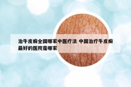 治牛皮癬全國哪家中醫(yī)療法 中國治療牛皮癬最好的醫(yī)院是哪家