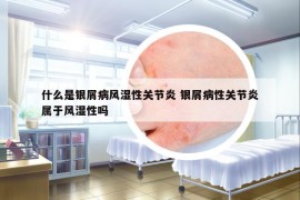 什么是銀屑病風(fēng)濕性關(guān)節(jié)炎 銀屑病性關(guān)節(jié)炎屬于風(fēng)濕性嗎