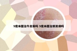 9度米醋治牛皮癬嗎 9度米醋治銀屑病嗎