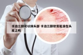 卡泊三醇可以抹頭部 卡泊三醇軟膏能涂在頭皮上嗎