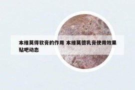 本維莫得軟膏的作用 本維莫德乳膏使用效果貼吧動態(tài)