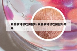 銀屑病可以吃保健嗎 銀屑病可以吃保健嗎知乎