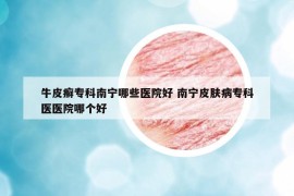牛皮癬?？颇蠈幠男┽t(yī)院好 南寧皮膚病專科醫(yī)醫(yī)院哪個好