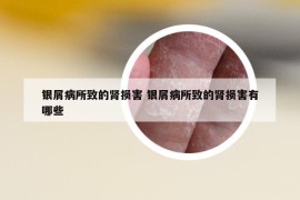 銀屑病所致的腎損害 銀屑病所致的腎損害有哪些