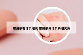 銀屑病有什么泡洗 銀屑病用什么藥泡洗澡