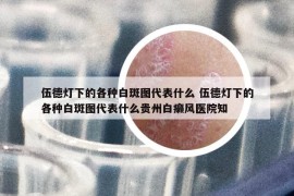 伍德燈下的各種白斑圖代表什么 伍德燈下的各種白斑圖代表什么貴州白癩風(fēng)醫(yī)院知