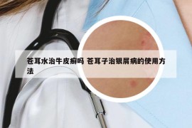 蒼耳水治牛皮癬嗎 蒼耳子治銀屑病的使用方法