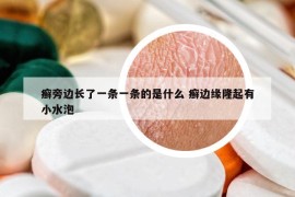癬旁邊長(zhǎng)了一條一條的是什么 癬邊緣隆起有小水泡