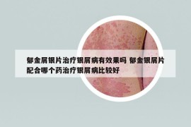 郁金屑銀片治療銀屑病有效果嗎 郁金銀屑片配合哪個藥治療銀屑病比較好