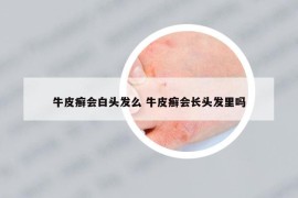 牛皮癬會白頭發(fā)么 牛皮癬會長頭發(fā)里嗎