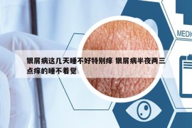 銀屑病這幾天睡不好特別癢 銀屑病半夜兩三點(diǎn)癢的睡不著覺(jué)