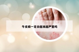 牛皮癬一定會越來越嚴(yán)重嗎