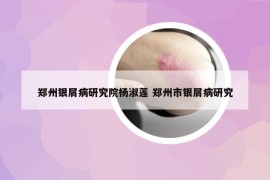 鄭州銀屑病研究院楊淑蓮 鄭州市銀屑病研究