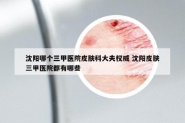 沈陽哪個(gè)三甲醫(yī)院皮膚科大夫權(quán)威 沈陽皮膚三甲醫(yī)院都有哪些