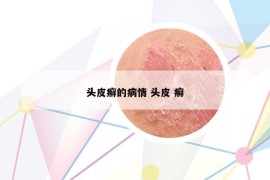 頭皮癬的病情 頭皮 癬