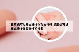 銀屑病可以用血液凈化儀治療嗎 銀屑病可以用血液凈化儀治療嗎視頻