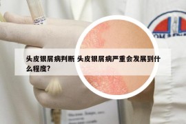 頭皮銀屑病判斷 頭皮銀屑病嚴重會發(fā)展到什么程度?