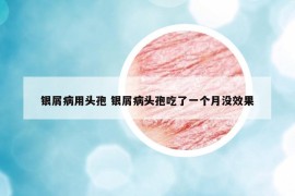 銀屑病用頭孢 銀屑病頭孢吃了一個(gè)月沒(méi)效果