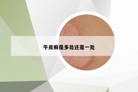牛皮癬是多處還是一處