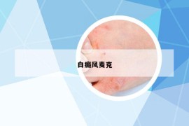 白癜風麥克