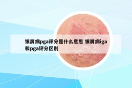 銀屑病pga評(píng)分是什么意思 銀屑病iga和pga評(píng)分區(qū)別