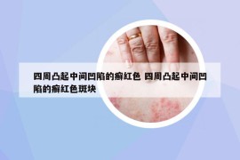 四周凸起中間凹陷的癬紅色 四周凸起中間凹陷的癬紅色斑塊