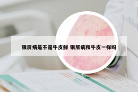 銀屑病是不是牛皮鮮 銀屑病和牛皮一樣嗎