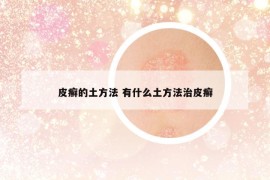 皮癬的土方法 有什么土方法治皮癬