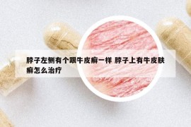 脖子左側(cè)有個跟牛皮癬一樣 脖子上有牛皮膚癬怎么治療