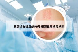 新疆適合銀屑病待嗎 新疆銀屑病發(fā)病率
