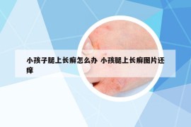 小孩子腿上長(zhǎng)癬怎么辦 小孩腿上長(zhǎng)癬圖片還癢