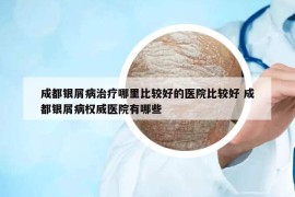 成都銀屑病治療哪里比較好的醫(yī)院比較好 成都銀屑病權威醫(yī)院有哪些